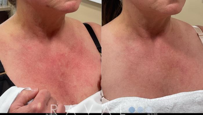 Before & After Skin Treatments Case 1114 View 2 View in Denver, CO