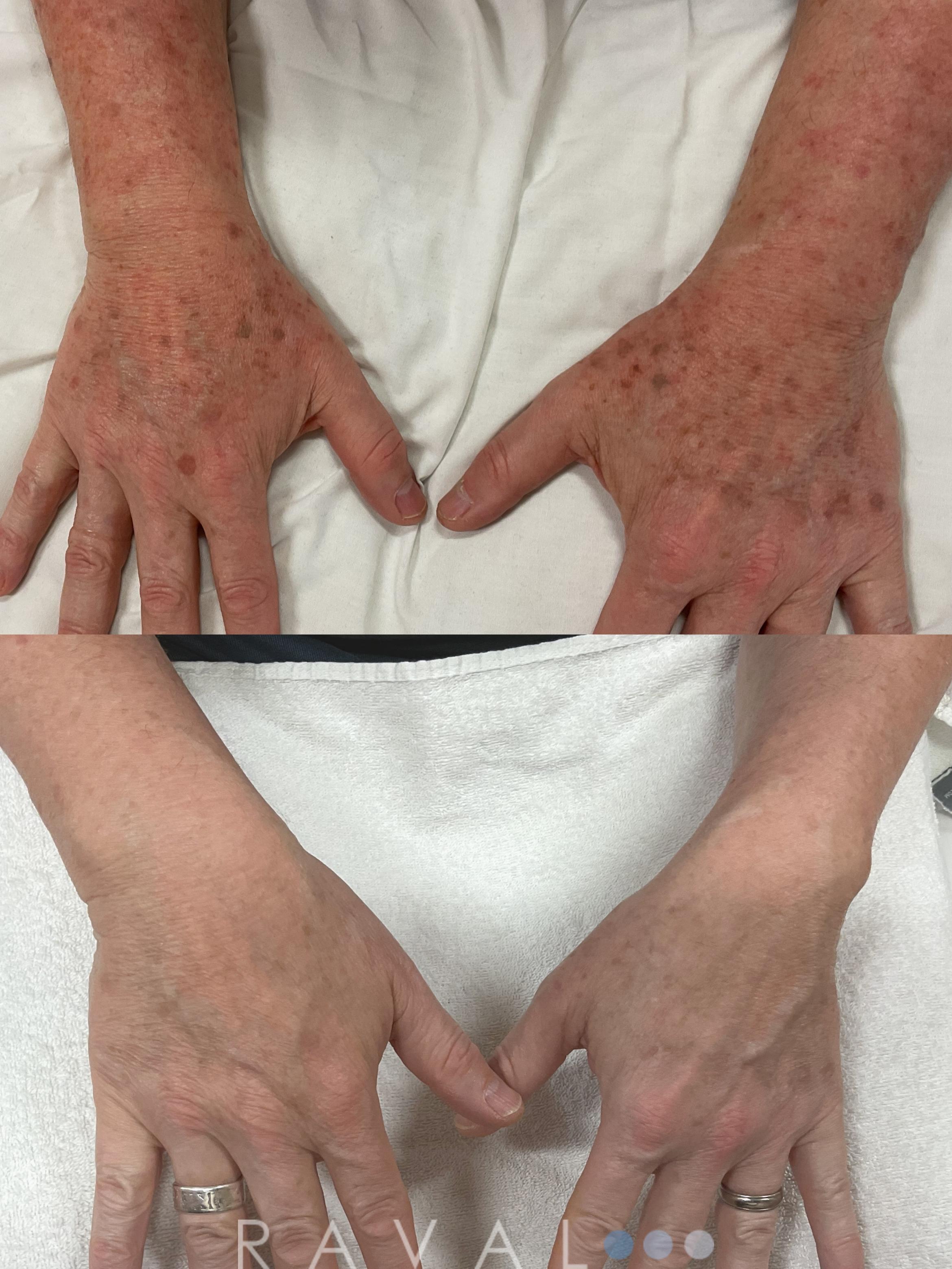 Before & After Skin Treatments Case 1115 View 1 View in Denver, CO